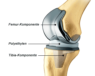 Schematischer Aufbau einer Knieprothese