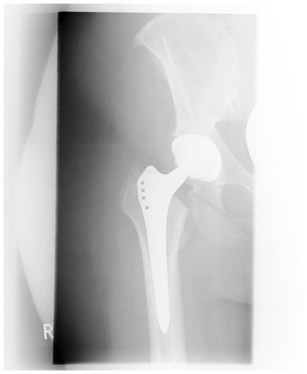 Röntgenbild einer implantierten Hüftprothese (Hüft-TEP)