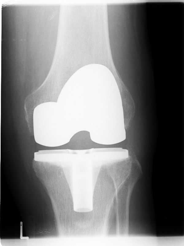 Röntgenbild einer implantierten Knieprothese (Knie-TEP)