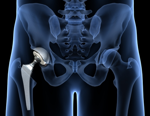 Schematische Darstellung einer implantierten Standard-Hüftprothese
